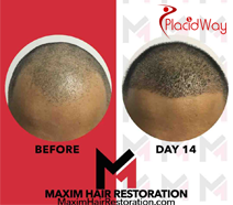 Slider image (2) MAXIM Hair Restoration Philippines